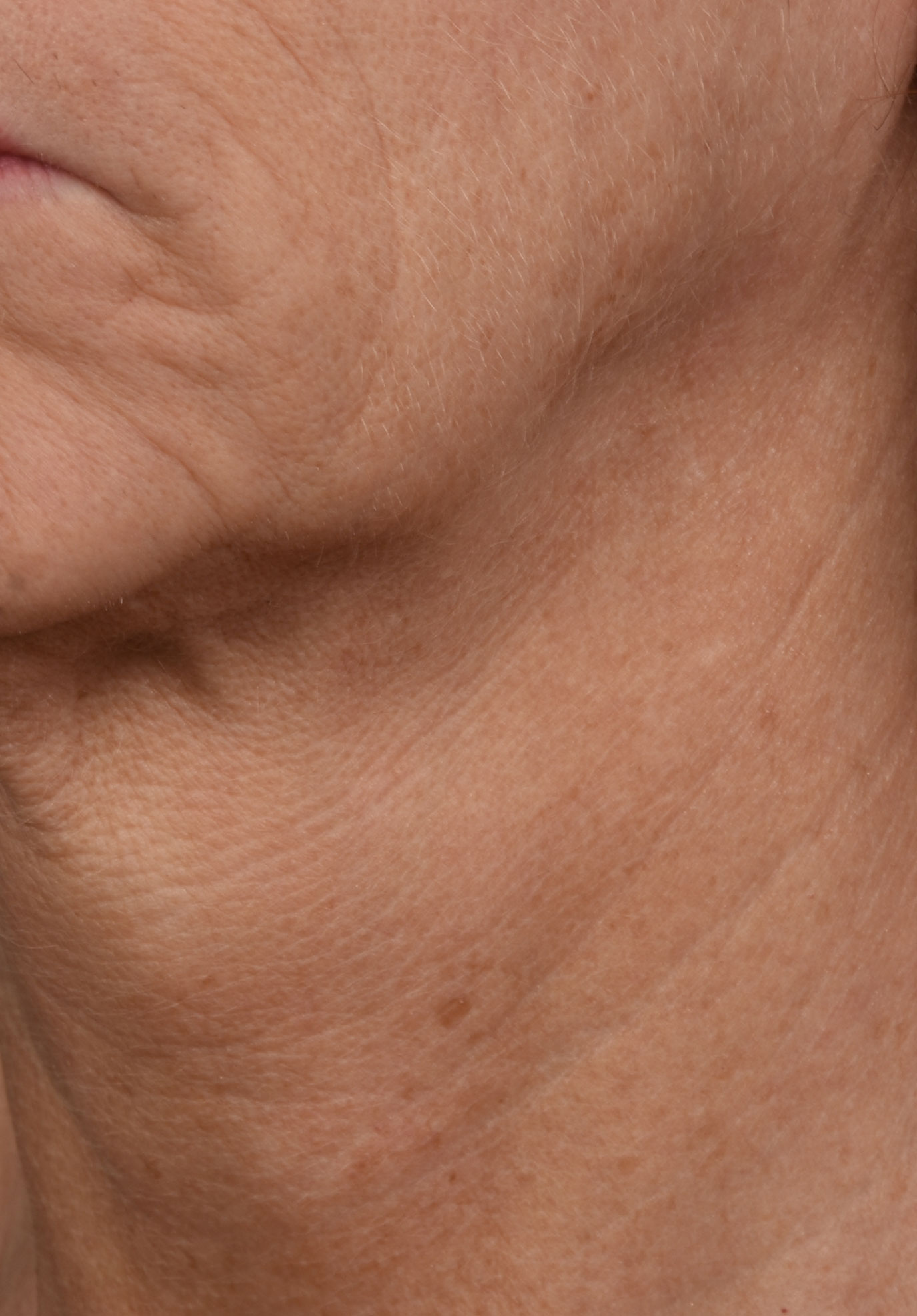 Skinpen-BA-Before-01.DQTVJcEJ SkinPen B 1