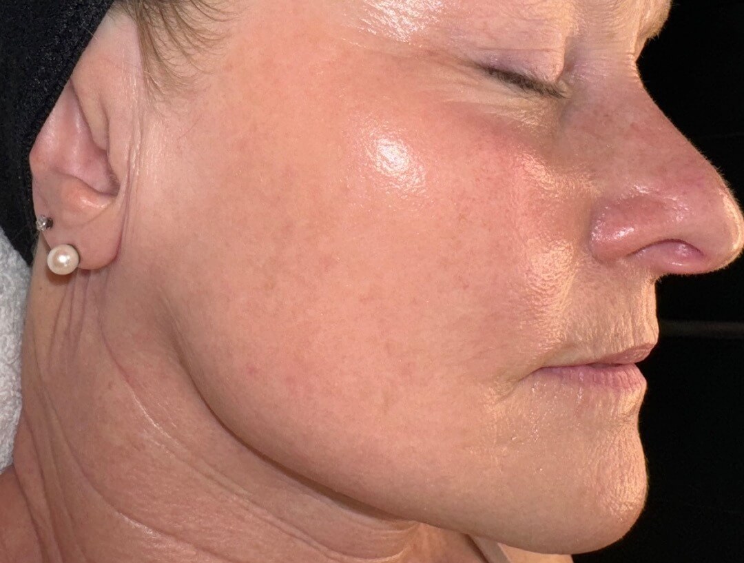 Skinpen-BA-Before-01.DQTVJcEJ SkinPen B 1
