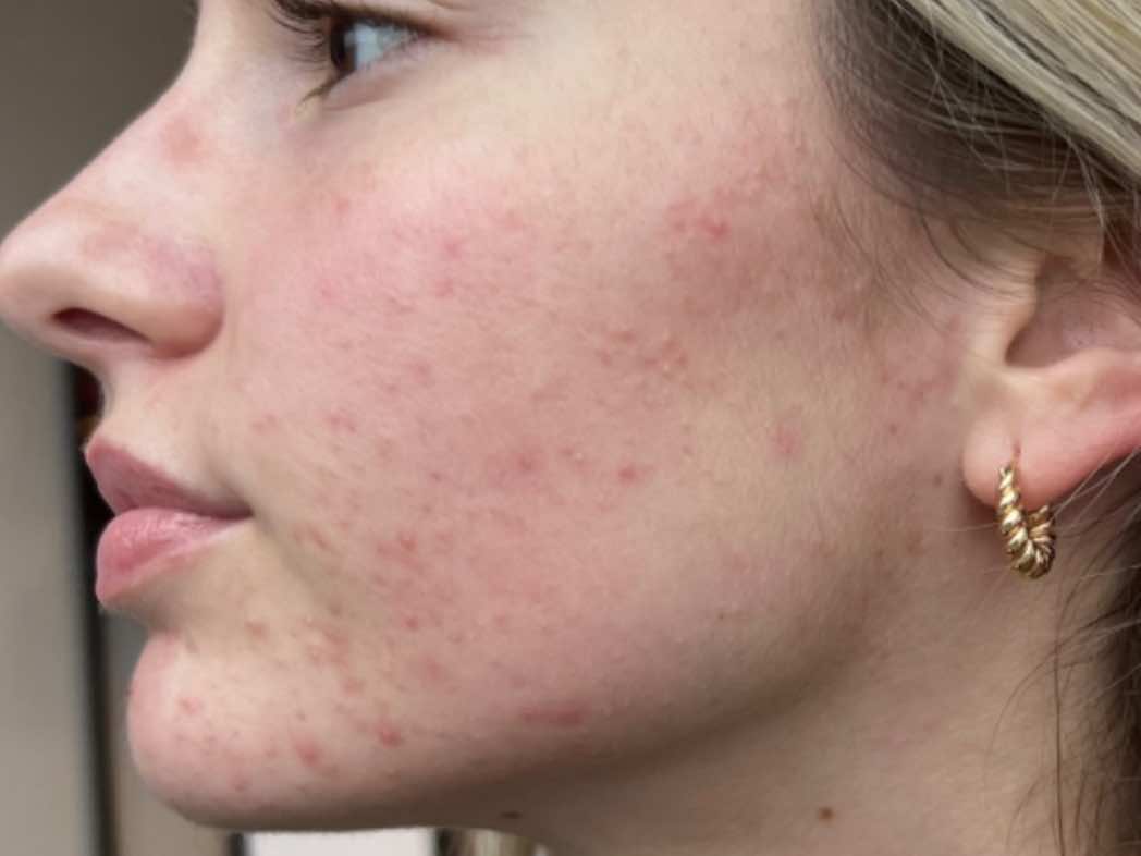 Skinpen-BA-Before-01.DQTVJcEJ SkinPen B 1