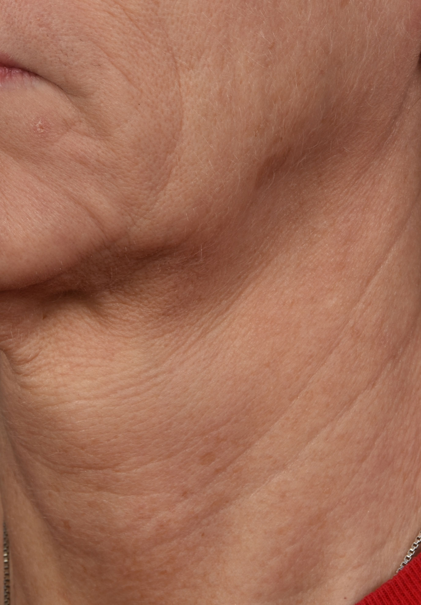 Skinpen-BA-Before-01.DQTVJcEJ SkinPen B 1
