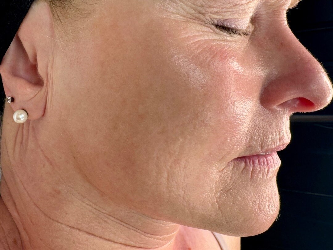 Skinpen-BA-Before-01.DQTVJcEJ SkinPen B 1