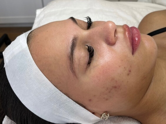 Skinpen-BA-Before-07.DULW7d1N SkinPen B 6